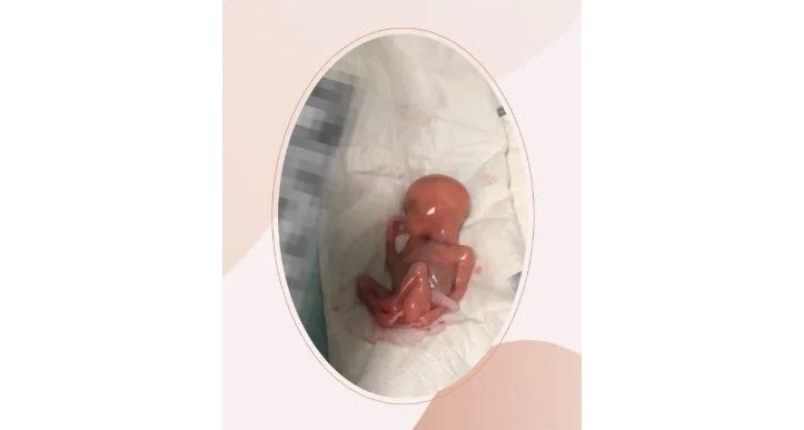 Samuele, Condannato a Morte dall’Industria dell’Aborto, si Succhiava il Pollice... Samuele